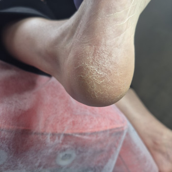 Обробка мозолі/натоптню
                    Салон красоты OH NAILS Одесса