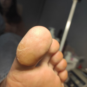 Обробка мозолі/натоптню
                    Салон красоты OH NAILS Одесса