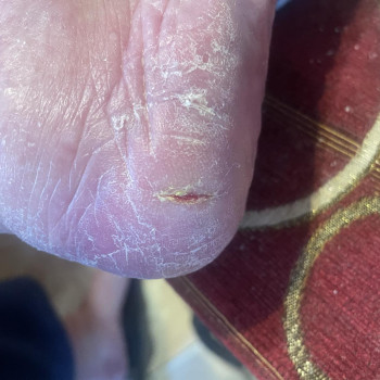 Обробка мозолі/натоптню
                    Салон красоты OH NAILS Одесса