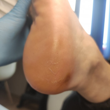 Обробка мозолі/натоптню
                    Салон красоты OH NAILS Одесса