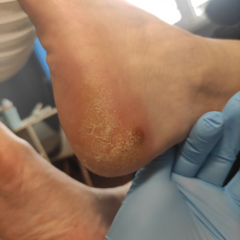 Обробка мозолі/натоптню
                    Салон красоты OH NAILS Одесса