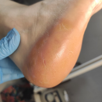 Обробка мозолі/натоптню
                    Салон красоты OH NAILS Одесса