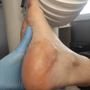 Обробка мозолі/натоптню
                    Салон красоты OH NAILS Одесса