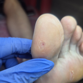 Обробка мозолі/натоптню
                    Салон красоты OH NAILS Одесса