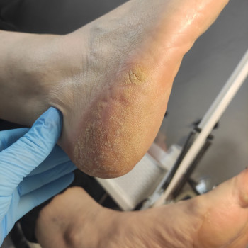 Обробка мозолі/натоптню
                    Салон красоты OH NAILS Одесса