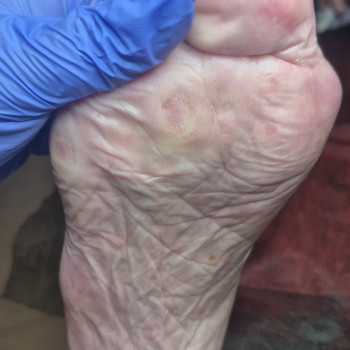 Обробка мозолі/натоптню
                    Салон красоты OH NAILS Одесса