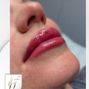 Перманентний макіяж губ:
після процедури (фото №3)

   