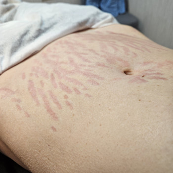 одразу після процедури