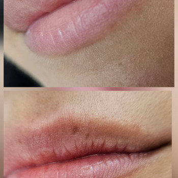 результат після двух процедур