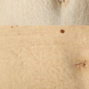 результати після першої процедури