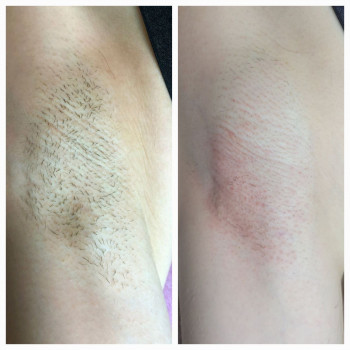 Електроепіляція