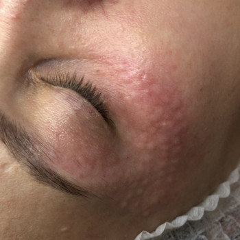 Біоревіталізація