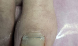 Корекция вросшего ногтя Салон краси Наоми Кривий Ріг