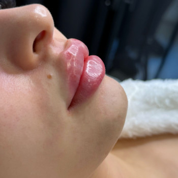 Збільшення губ
 
 
 