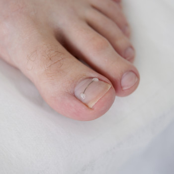 Фото из портфолио специалиста Владлена Харченко (подолог, Хмельницкий)