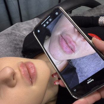 Збільшення губ
 
 