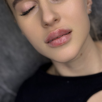 Збільшення губ
 
 
 