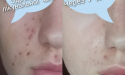 Комбінована чистка обличчя Косметолог-эстетист Елена Житомир