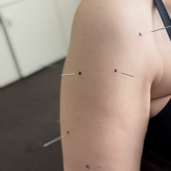 Акупунктура "Сухая игла"
                    Массажный салон Beauty Spa Запорожье