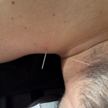 Акупунктура "Сухая игла"
                    Массажный салон Beauty Spa Запорожье