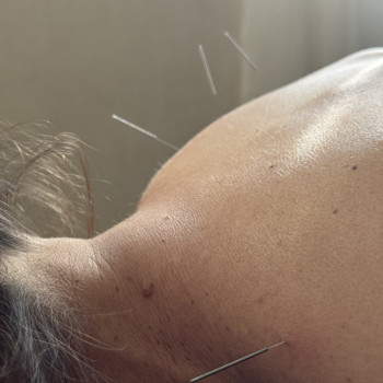 Акупунктура "Сухая игла"
                    Массажный салон Beauty Spa Запорожье