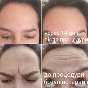 за допомогою ботулотоксину можна позбавитись мімічних зморшок за одну процедуру на тривалий час
