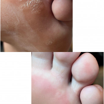 планетарні кластерні бородавки