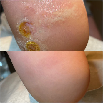 мозаїчні бородавки