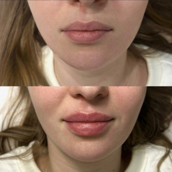 Увеличение губ Препарат stylage m – 1 мл, фото - Косметолог София Летюка