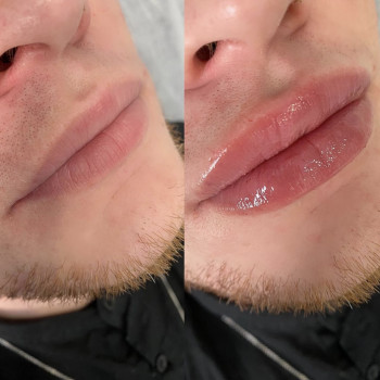 Збільшення губ  Препарат Neuramis - 1 мл, фото - Косметолог Софія Летюка