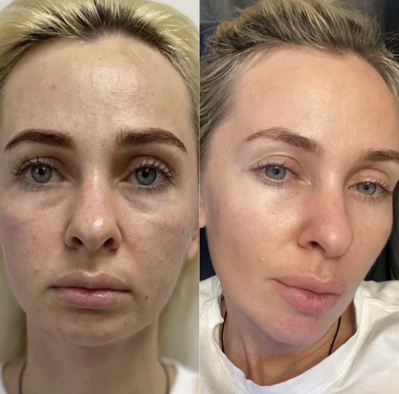 Біоревіталізація, фото - Косметолог София Летюка