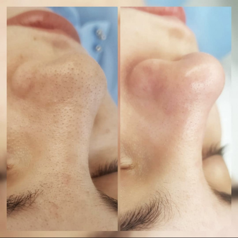 Чистка обличчя, фото - Косметолог София Летюка