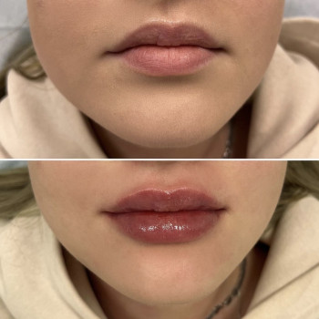 Збільшення губ Препарат Neuramis - 1 мл, фото - Косметолог Софія Летюка