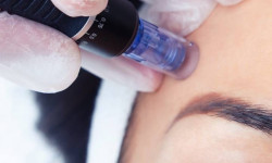 Фракційна мезотерапія (мікронідлінг) Косметолог  Стрый