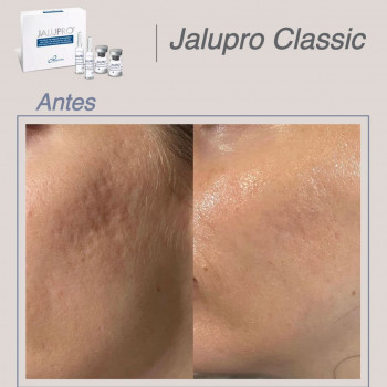 JALUPRO Classic 
                    Косметолог София Одесса
