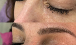 Виделення шрамів/рубців мікронідлінг Мастер перманентного макияжа София Кременчуг