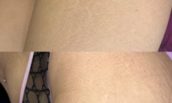 Видалення розтяжок/стриїв мікронідлінг Майстер перманентного макіяжу София Кременчук