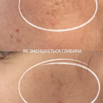 Фракційна мезотерапія обличчя/ Мікронідлінг обличчя
                    Майстер перманентного макіяжу София Кременчук