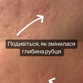 Фракційна мезотерапія обличчя/ Мікронідлінг обличчя
                    Майстер перманентного макіяжу София Кременчук