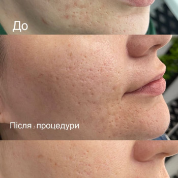 Фракційна мезотерапія обличчя/ Мікронідлінг обличчя
                    Майстер перманентного макіяжу София Кременчук