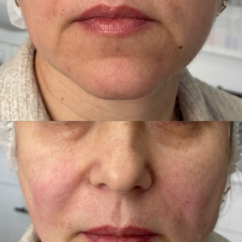 Безопераційна підтяжка обличчя мезонитками