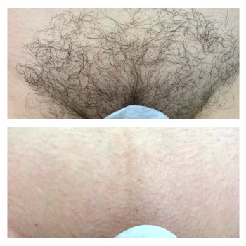  #депиляциябикини
 #депиляциявоском
 #шугаринг
 #депиляциякие
 #шугарінгкиїв
