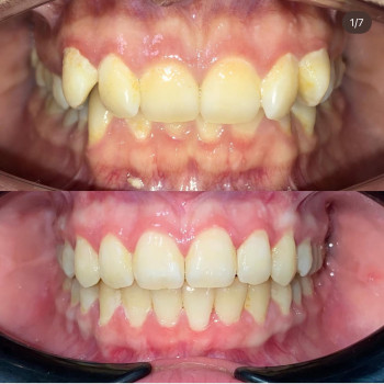 Выравнивание зубов, исправление прикуса, брекеты
                    Стоматолог Любовь Чернигов