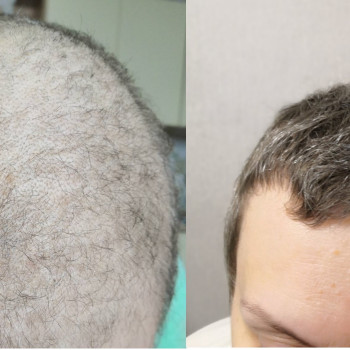 Дифузне випадіння волосся після хіміотерапії