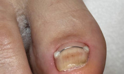 Встановлення корекційної системи Нігтьова студія Маникюрный дом Одеса