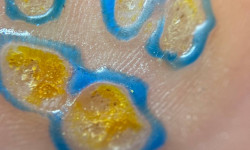 Видалення бородавки Нігтьова студія Маникюрный дом Одеса