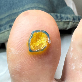 Видалення бородавки
                    Нігтьова студія Маникюрный дом Одеса