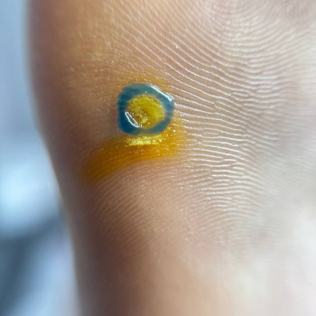 Видалення бородавки
                    Нігтьова студія Маникюрный дом Одеса