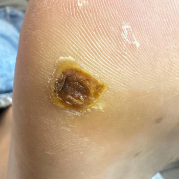 Видалення бородавки
                    Нігтьова студія Маникюрный дом Одеса