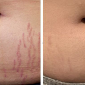 Мікронідлінг розтяжок